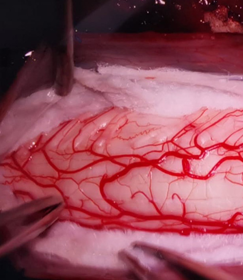 tumora-intramedulara